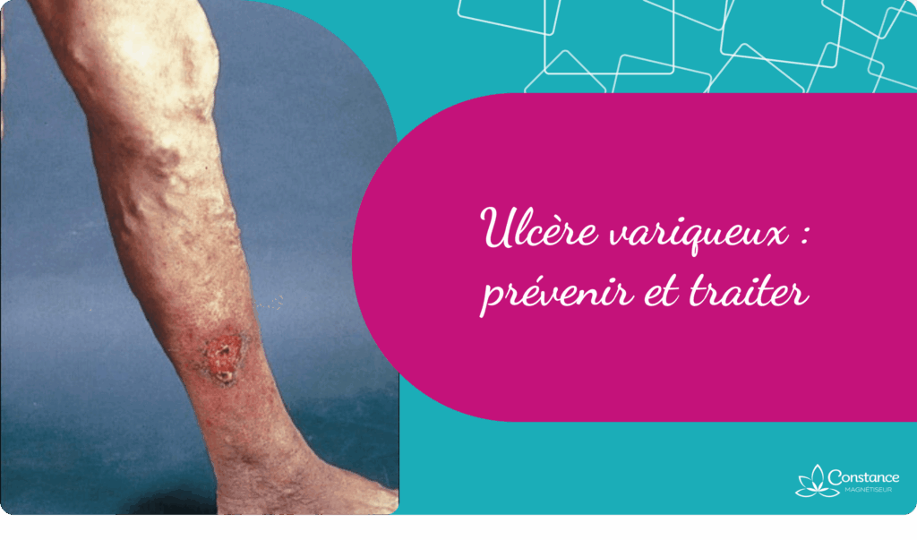 Ulcère variqueux : prévenir et traiter