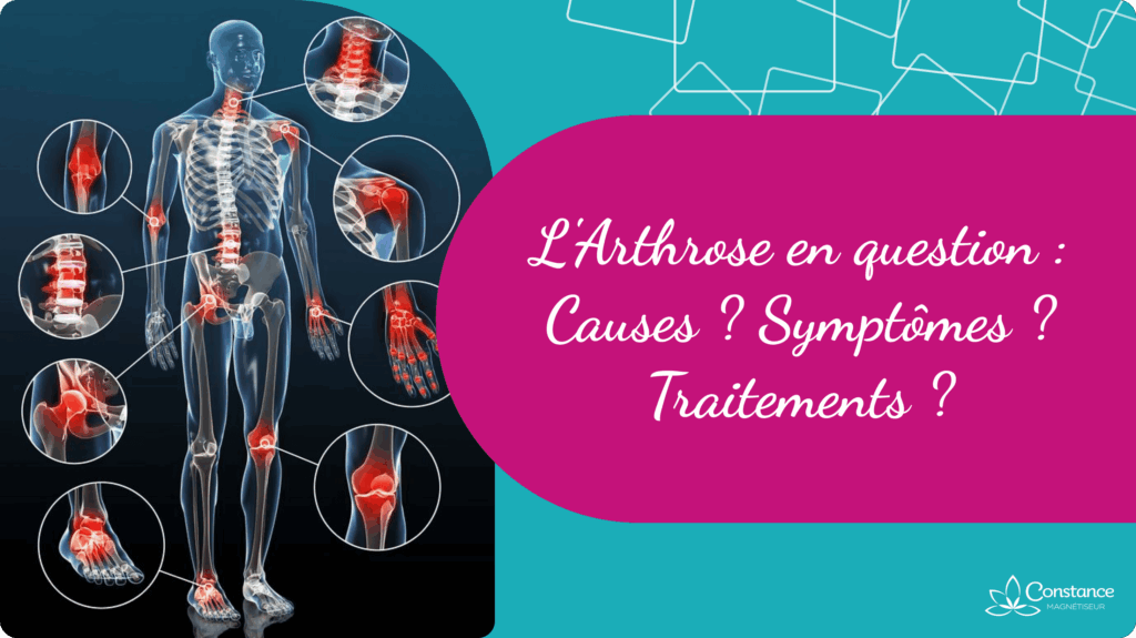 Qu’est-ce que l’arthrose